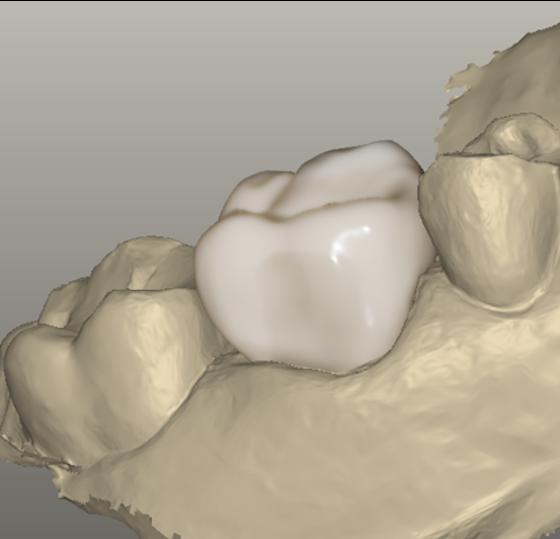 Final photorealistic dental rendering showing smooth enamel-dentine transitions