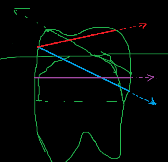Technical diagram showing intersection plane calculations for enamel-dentine transition